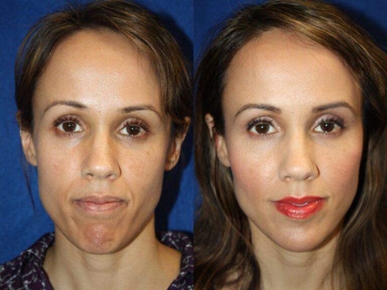 Revitalize Your Look with Dermal Fillers in Islamabad