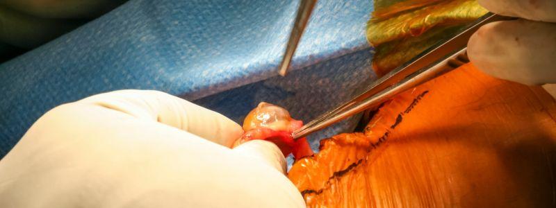Advantages of Occipital Nerve Surgery