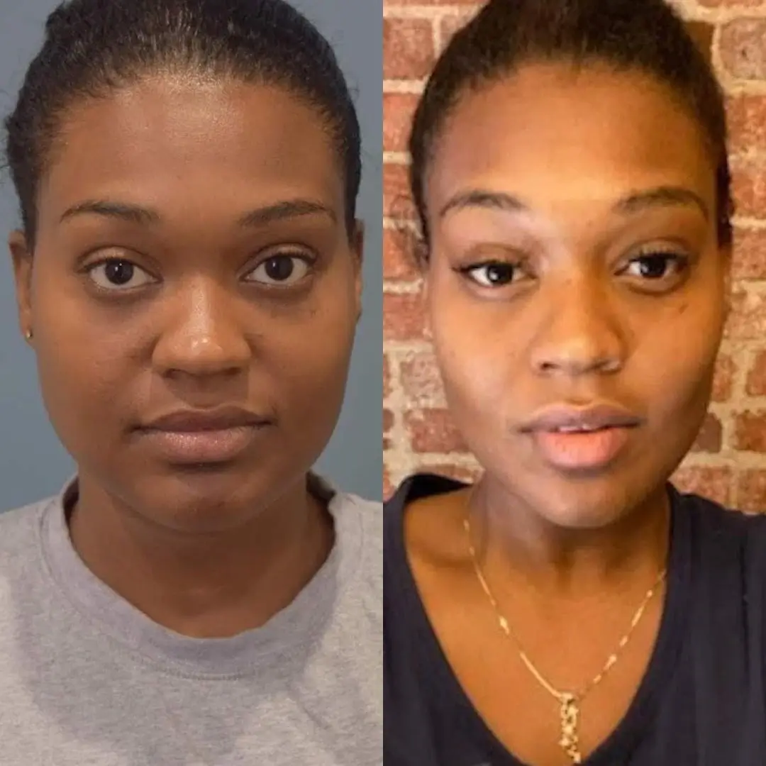 Buccal-Fat-Removal-before-and-after-uae Buccal Fat Removal