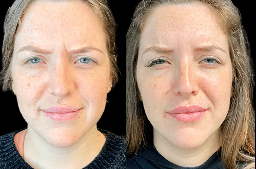 H2-Botox