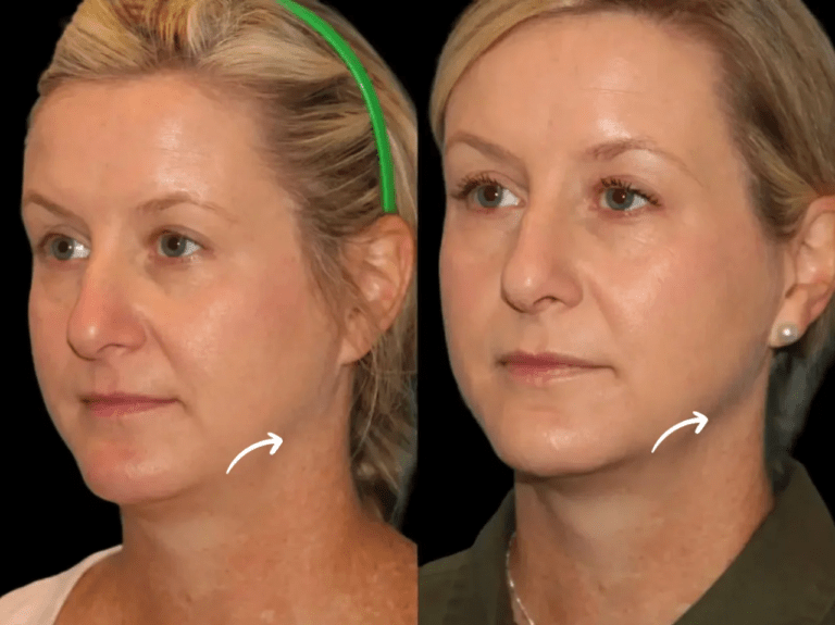 Why Sculptra is a Great Choice for Aging Skin at the Best Aesthetic Clinic in dubai