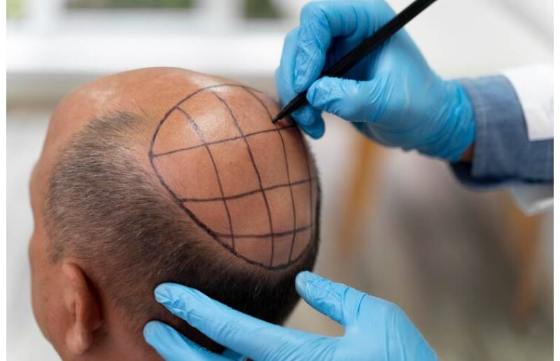 DHI hair transplant in Istanbul