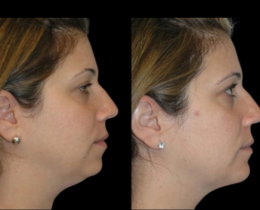Double Chin removal