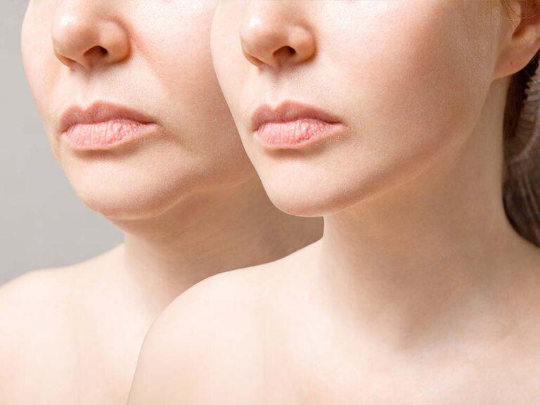Can Dermal Fillers Enhance Your Natural Beauty?
