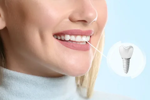 Affordable Dental Implants Dulwich Hill: Flexible Treatment Options
