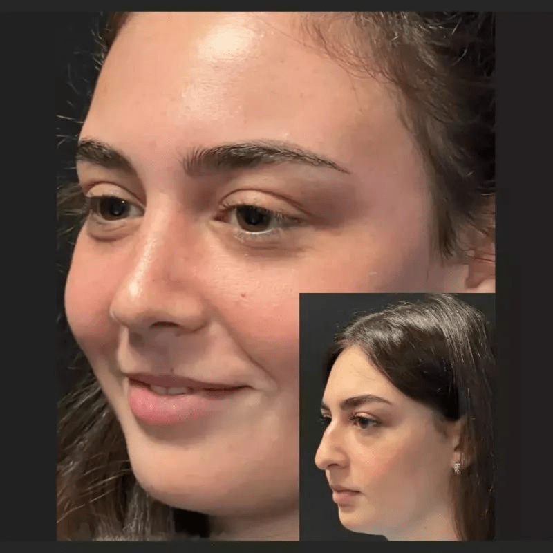 Discover the Best Doctors in Dubai for Rhinoplasty Results Discover the Best Doctors in Dubai for Rhinoplasty Results