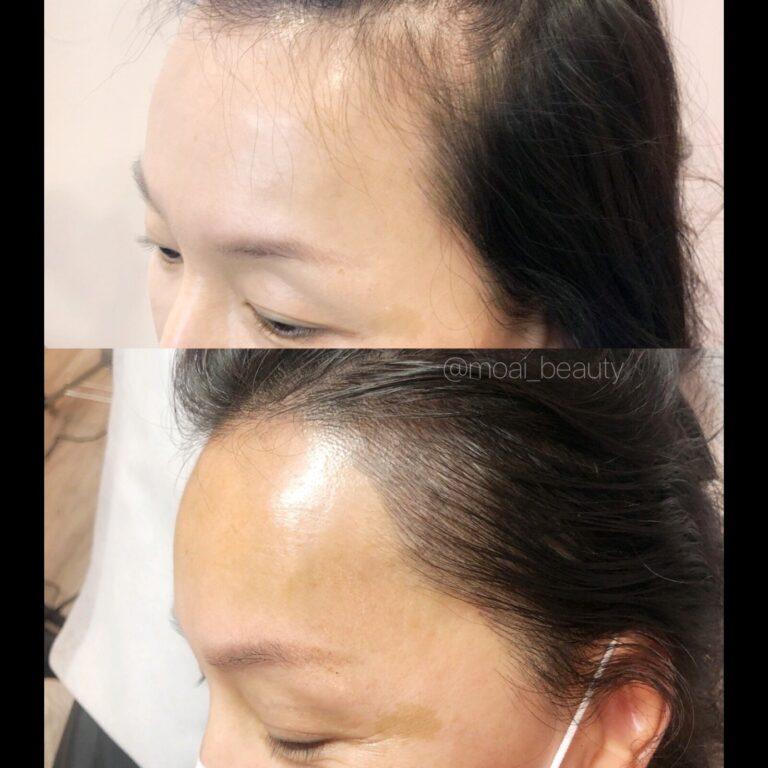The Innovative Solution for Hair Loss