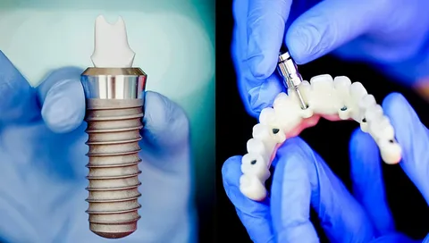 Revolutionize Your Smile With Dental Implants Leichhardt