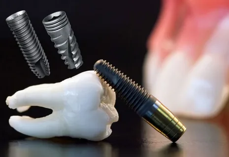dental implants Alexandria