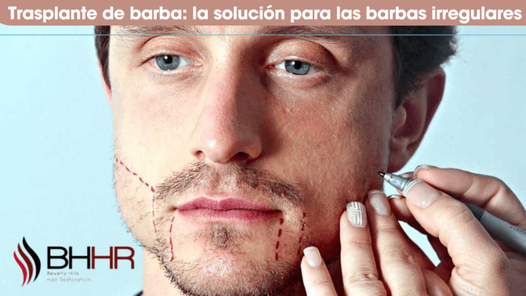 transplante de barba