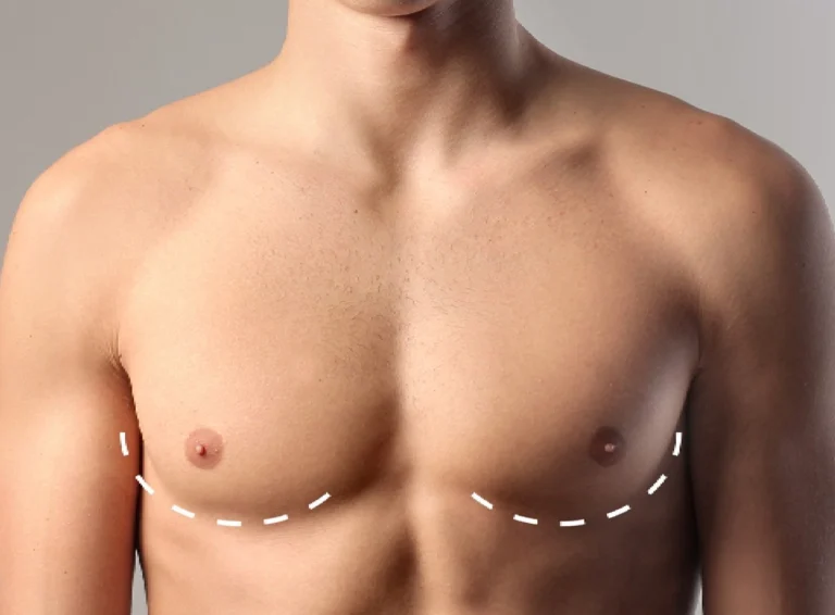Why the Best Gynecomastia Surgeon in dubai Are Leading the Way in Male Breast Reduction