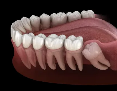 wisdom teeth removal enmore,