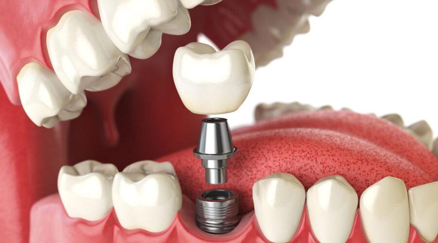 dental implants marietta ga