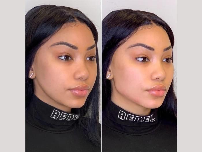 Combining a Thread Lift with Filler Advice from the Best Plastic Surgeon in Dubai
