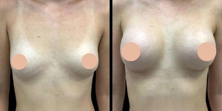 What to Expect During a Consultation with the Best Doctors in Dubai for Breast Augmentation