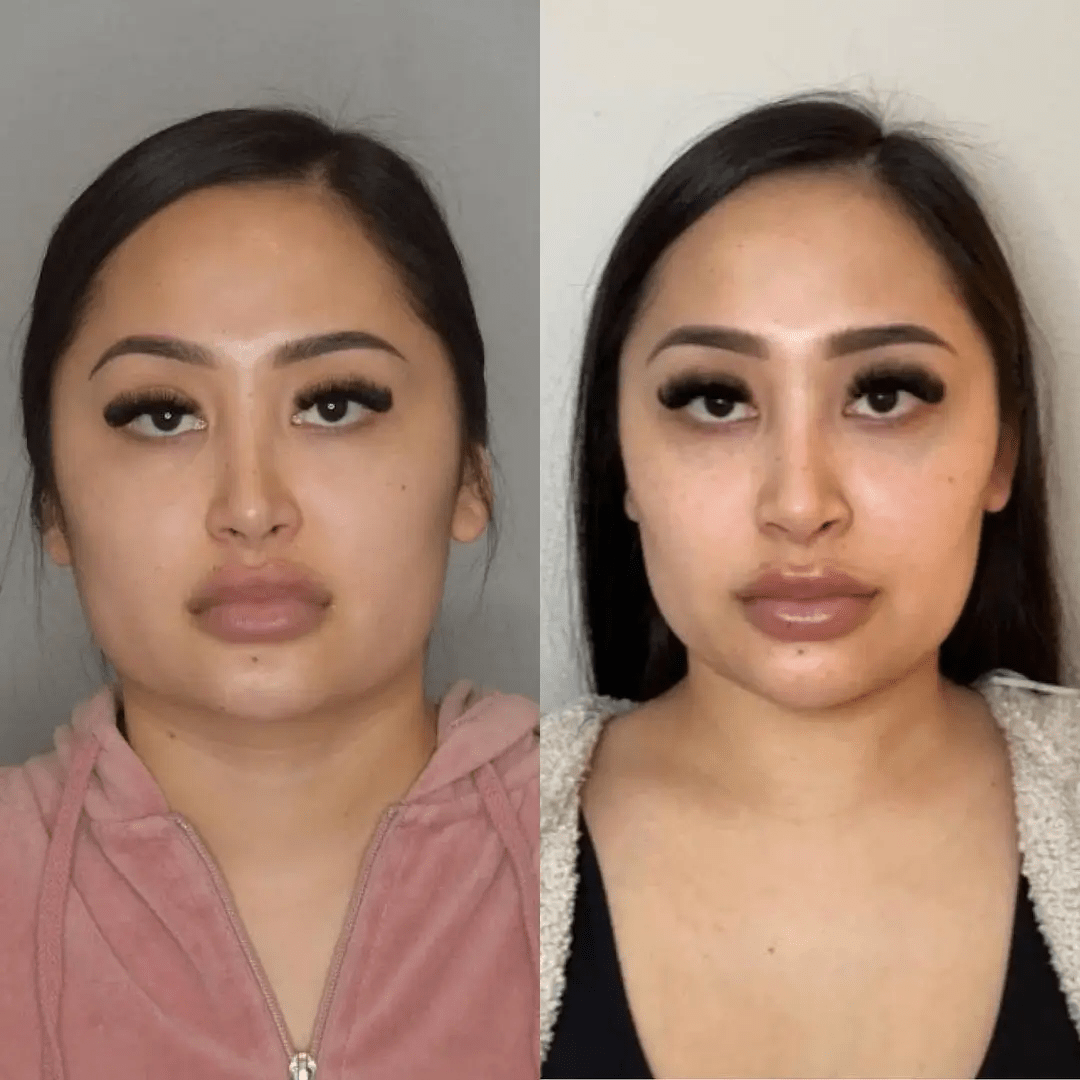 Buccal Fat Removal