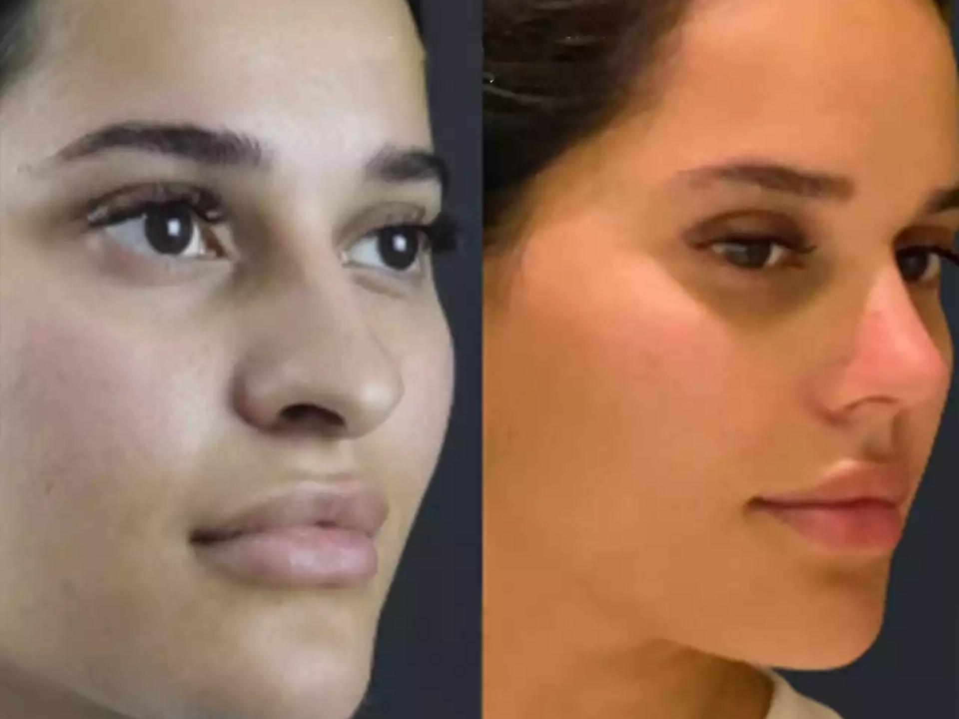 H-Rhinoplasty rhinoplasty in dubai