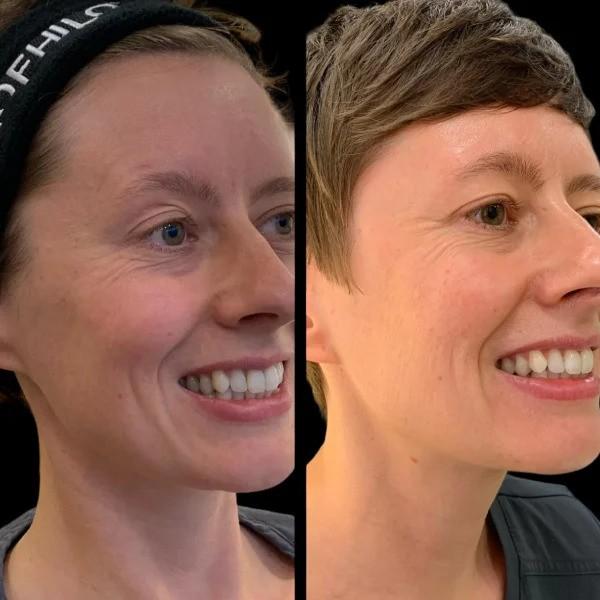 How Often Should You Get Profhilo Treatment in Dubai for Optimal Results