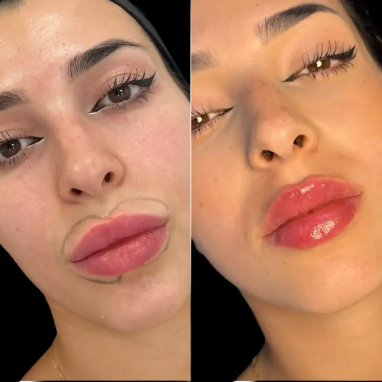 Expert Guide: Best Doctors in dubai for Fillers A Non-Surgical Facial Rejuvenation