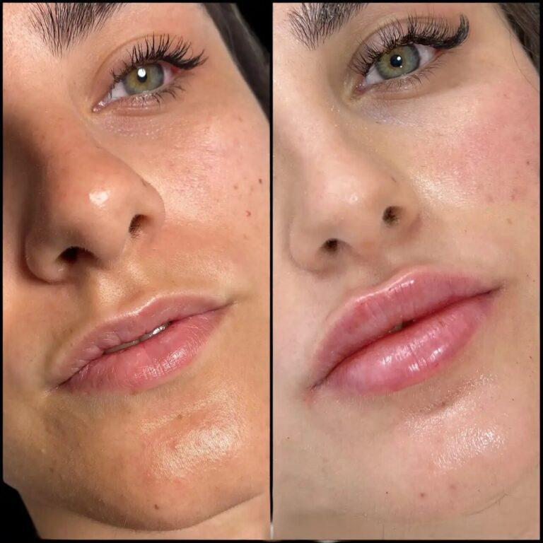 How the Best Aesthetic Clinics in dubai Deliver Exceptional Fillers Results
