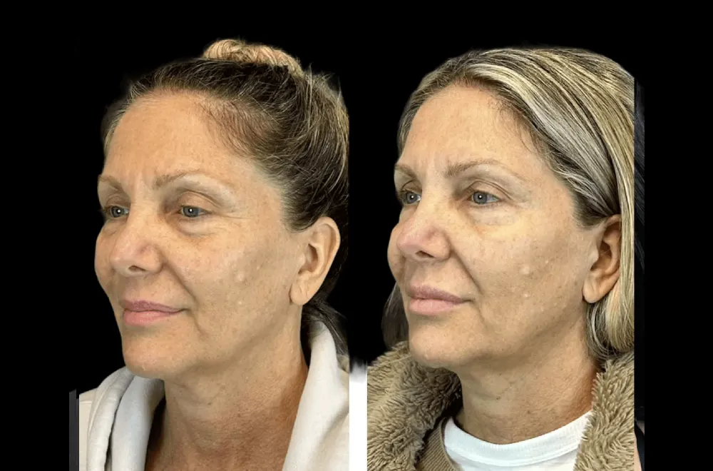 H9-Botox Botox in dubai