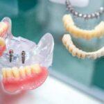 Implants