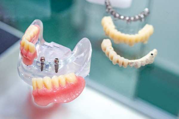 dental implants Surrey