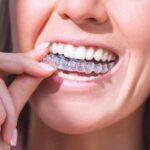 Invisalign
