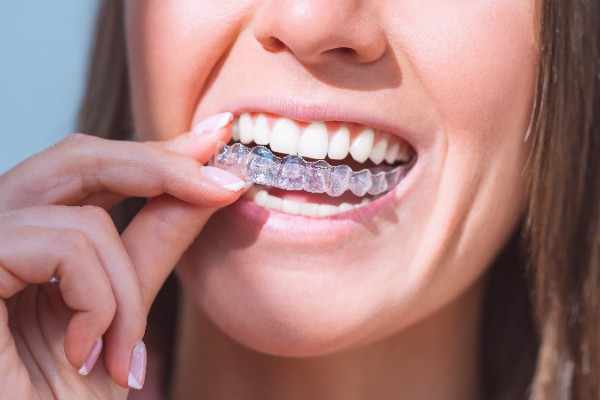  invisalign Surrey