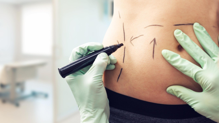 Liposuction in Dubai: The Different Types of Liposuction Procedures Explained