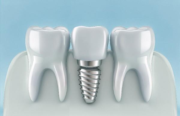Smilo Dental Implants