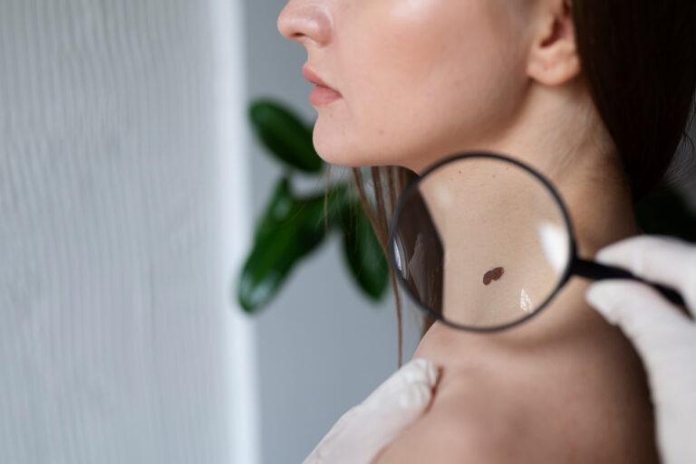 Warts and Skin Health