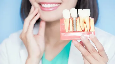Dental Implants Dulwich Hill: You Need to Know for a Smile
