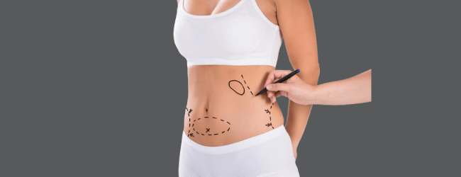 Best Liposuction in Dubai: How to Maintain Your Liposuction Results Long-Term