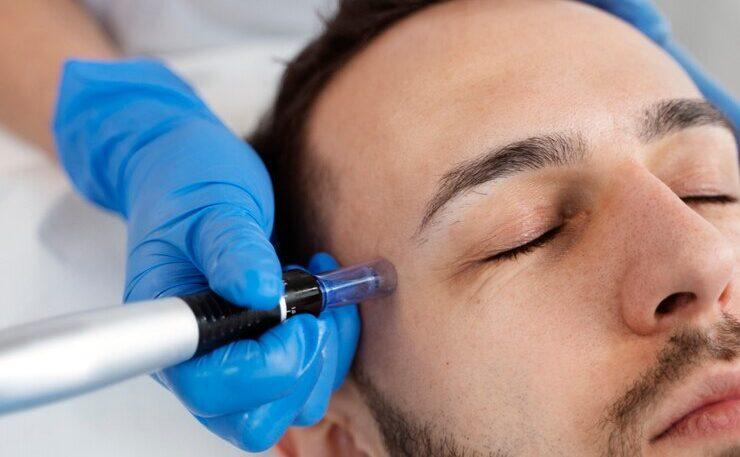 microneedling san antonio