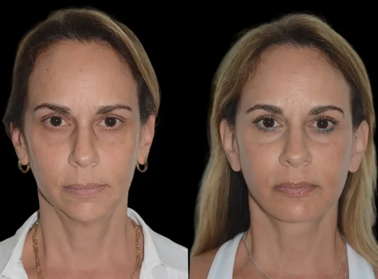 Best Aesthetic Clinic in dubai for Chin Fillers: Minimally Invasive Solutions
