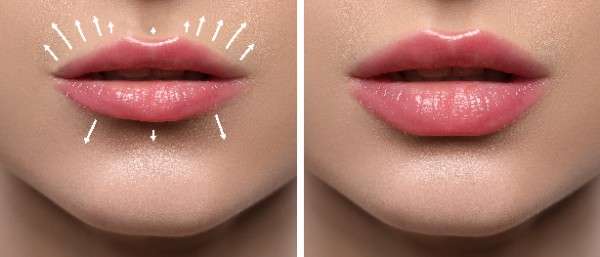 Lip Filler
