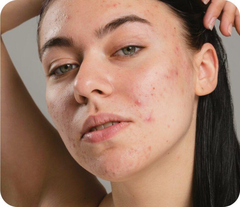 Acne Treatment In Dubai