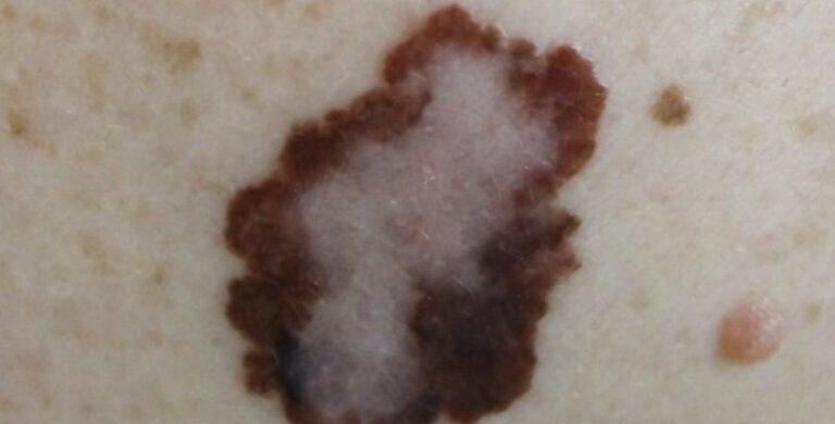melanoma treatment Laguna Hills CA
