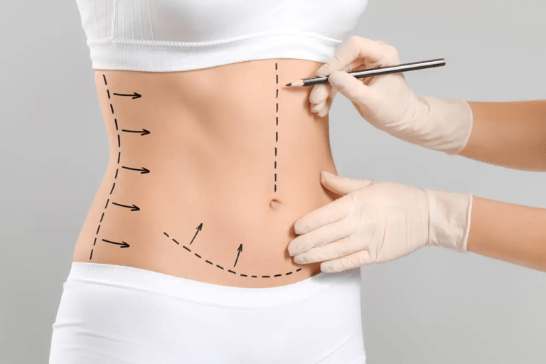 Tummy Tuck in Dubai