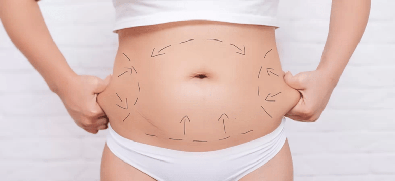 Full tummy tuck Islamabad