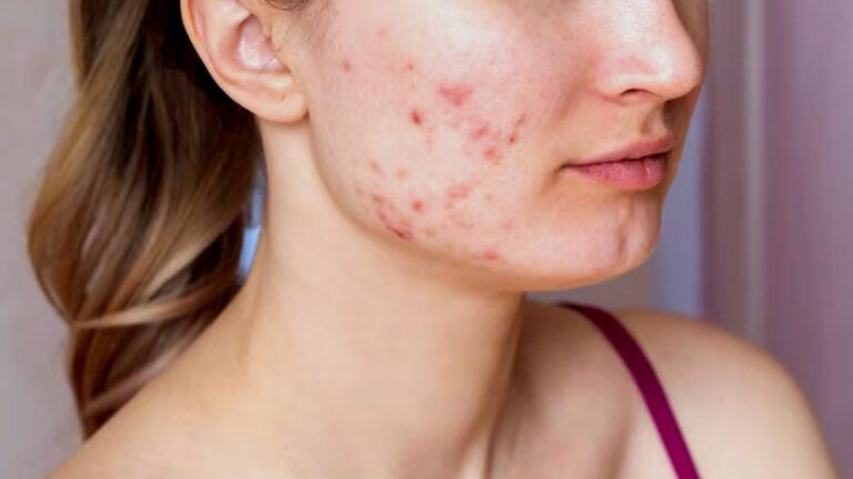 Acne Treatment In Dubai