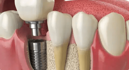 image 4 Mini, All-on-4 & Root‑Analogue Implants:Which One Suits You?