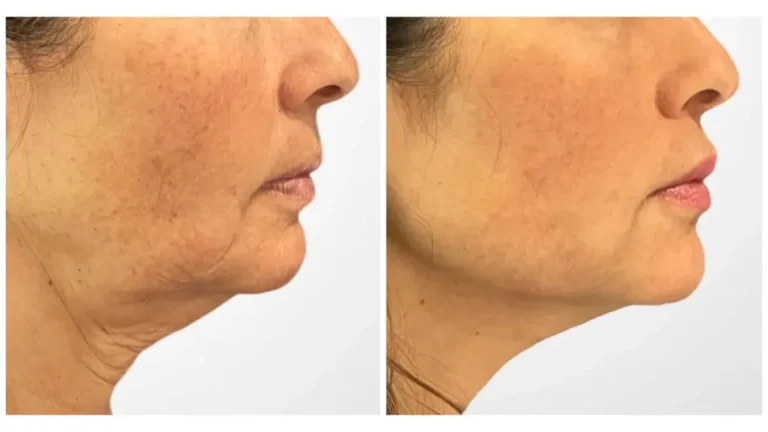 Thread Lift Treatment in Dubai: A Beginner’s Guide to Non-Surgical Facelifts
