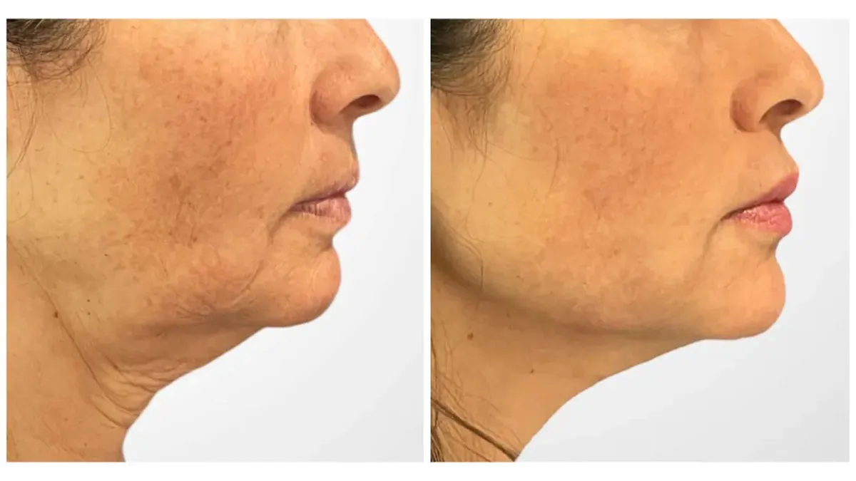 threadlifts aap Thread Lift Treatment in Dubai: A Beginner’s Guide to Non-Surgical Facelifts