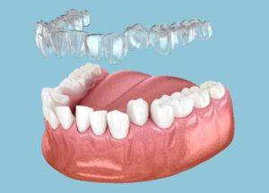 Invisalign
