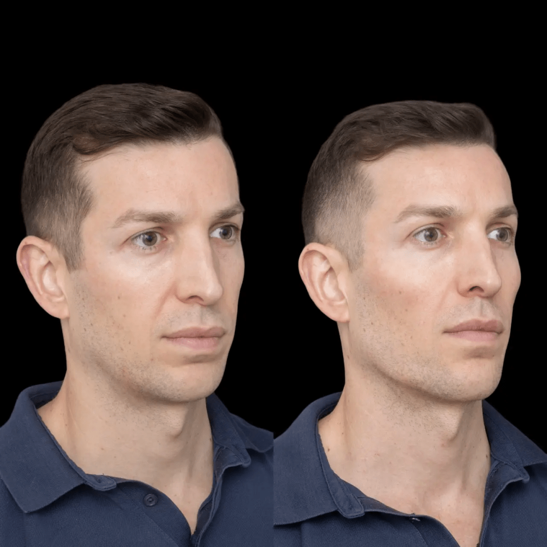 Jawline Fillers