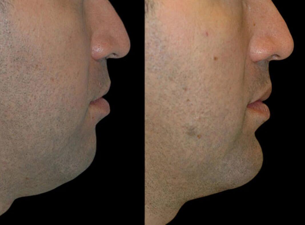 H3-Chin-Fillers-ezgif.com-webp-to-jpg-converter Chin Fillers in Dubai