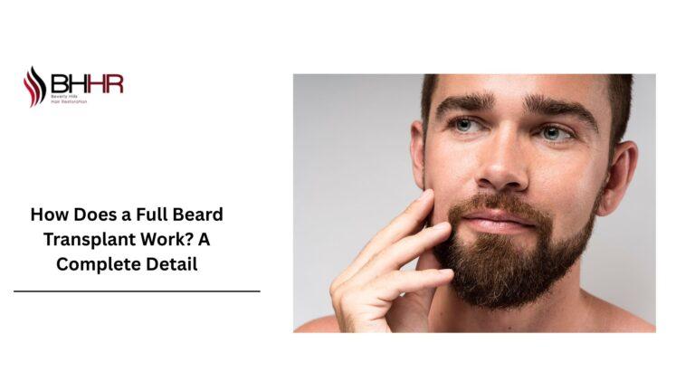 full beard transplant
