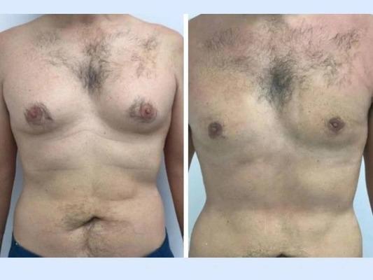 gynecomastia in Dubai
